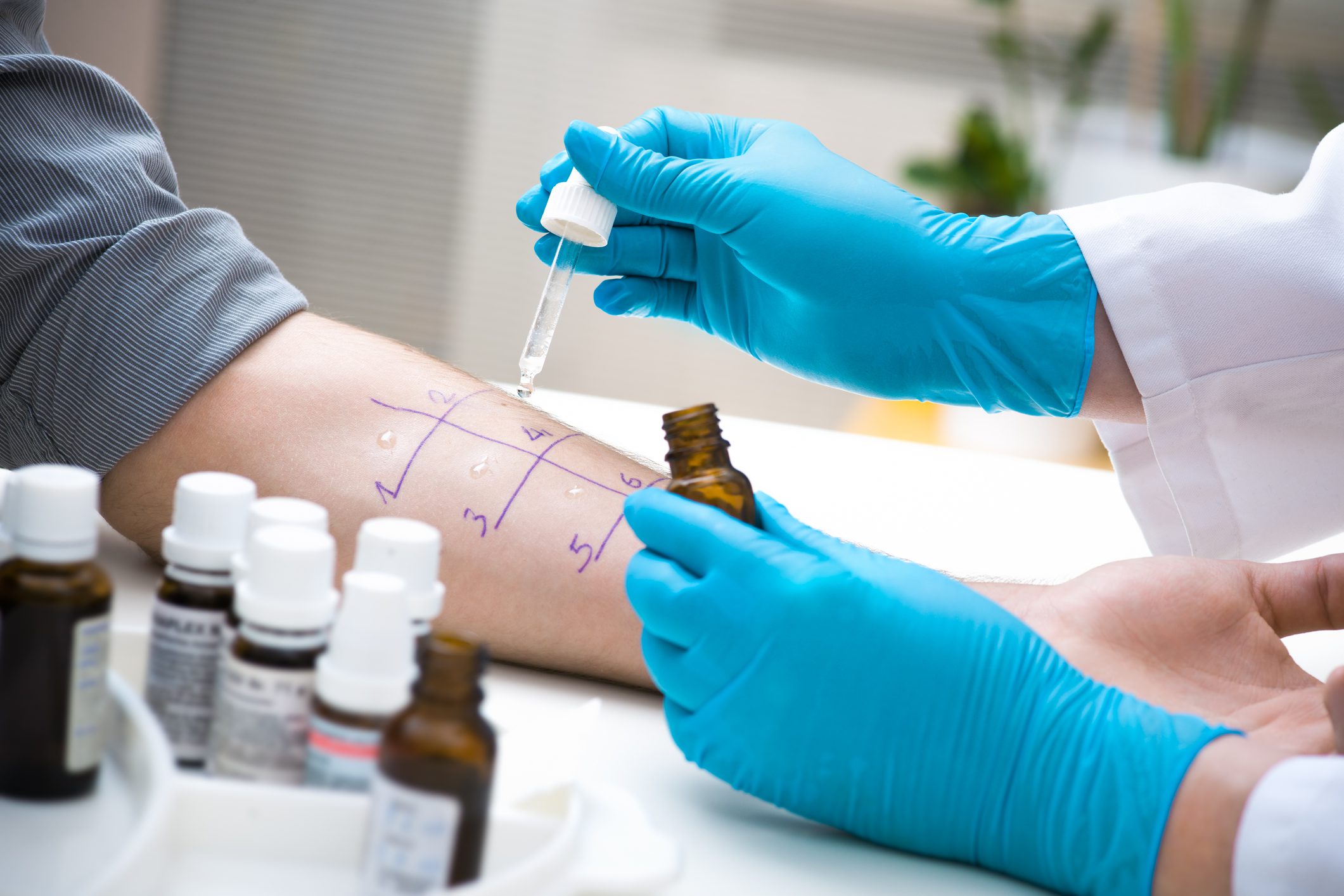 Is-It-Worth-Getting-An-Allergy-Test-Before-Travelling is-it-worth-getting-an-allergy-test-before-travelling